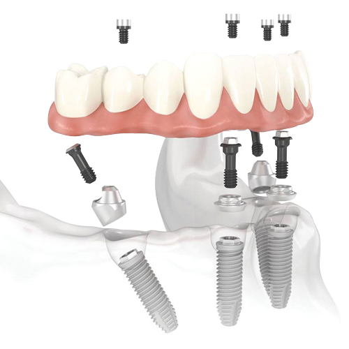 Illustration of fixed dentures attached to implants